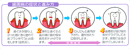 歯周病の症状と進み方